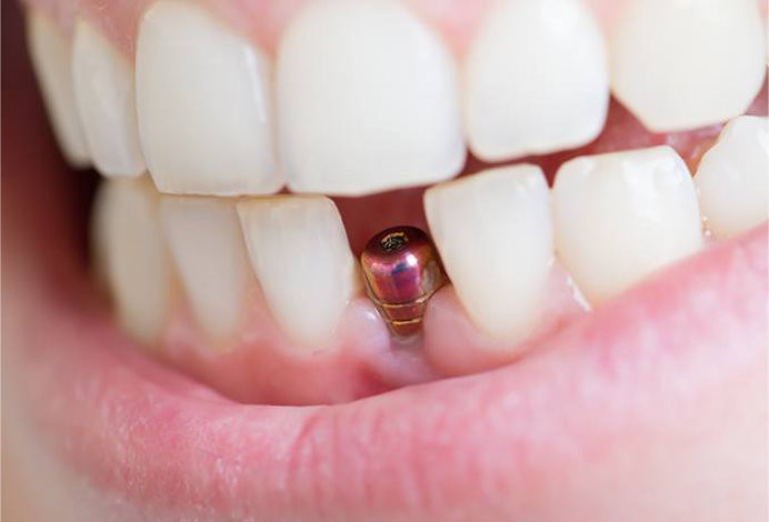 Sdelat-implantaciyu-zubov